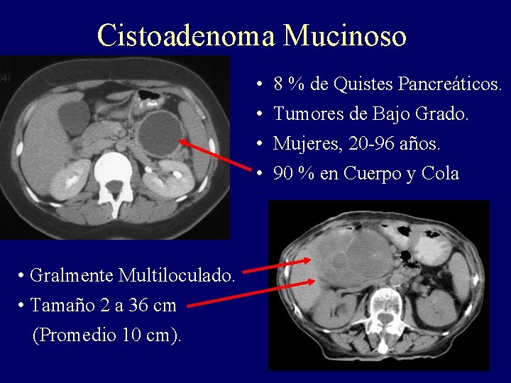 Cistoadenoma Mucinoso • • • Gralmente Multiloculado. • Tamaño 2 a 36 cm (Promedio