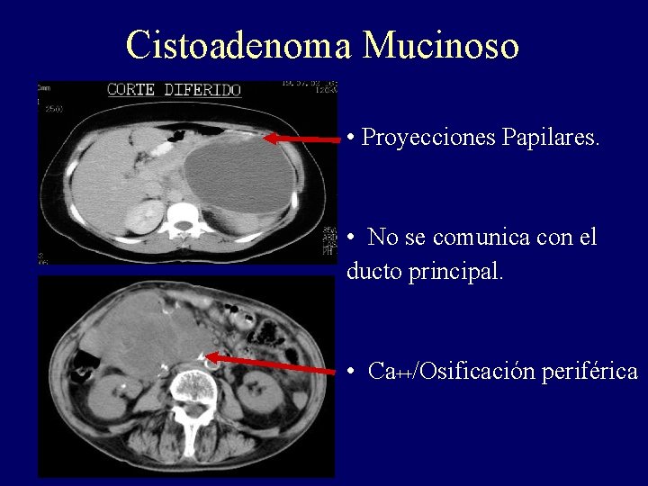 Cistoadenoma Mucinoso • Proyecciones Papilares. • No se comunica con el ducto principal. •