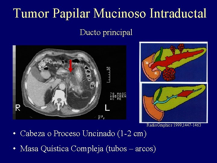 Tumor Papilar Mucinoso Intraductal Ducto principal Radio. Graphics 1999; 1447 -1463 • Cabeza o