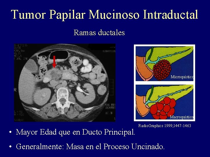 Tumor Papilar Mucinoso Intraductal Ramas ductales Microquístico Macroquístico • Mayor Edad que en Ducto