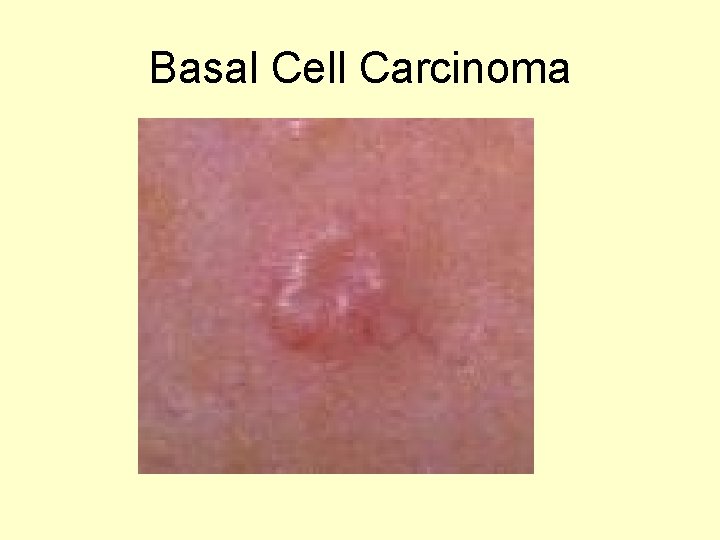 Basal Cell Carcinoma Basal Cell Carcinoma
