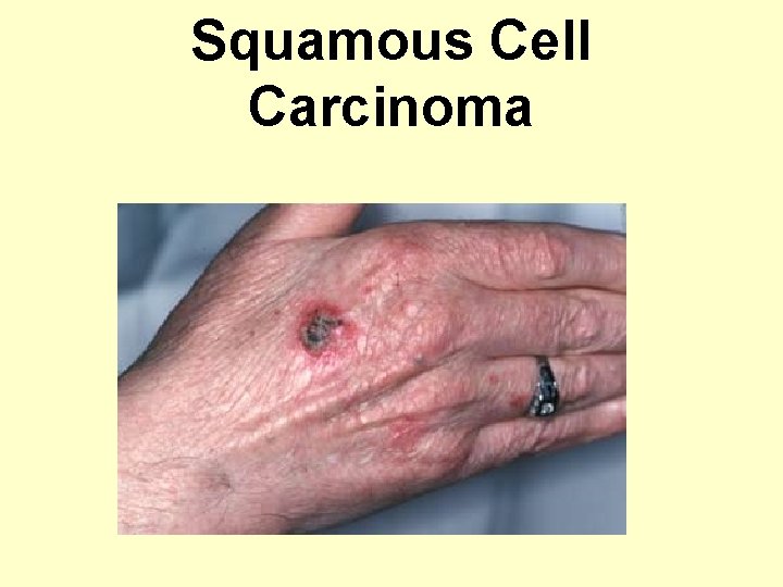 Squamous Cell Carcinoma 