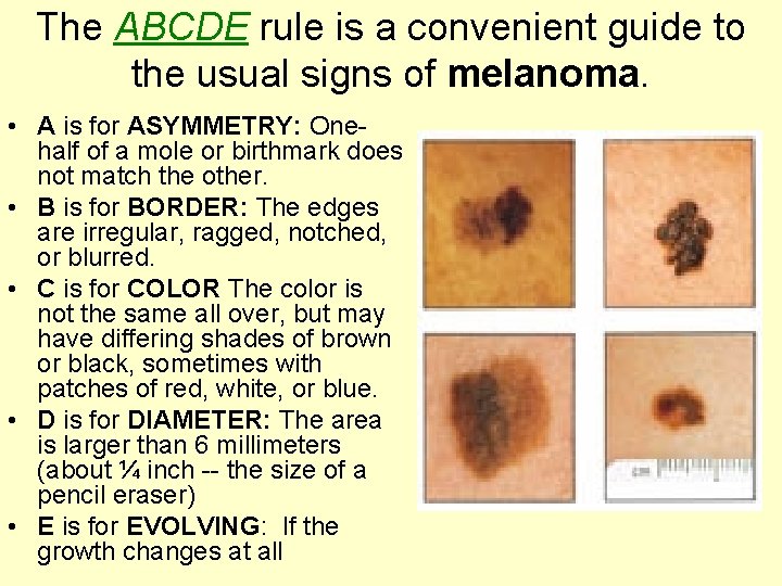 The ABCDE rule is a convenient guide to the usual signs of melanoma. •