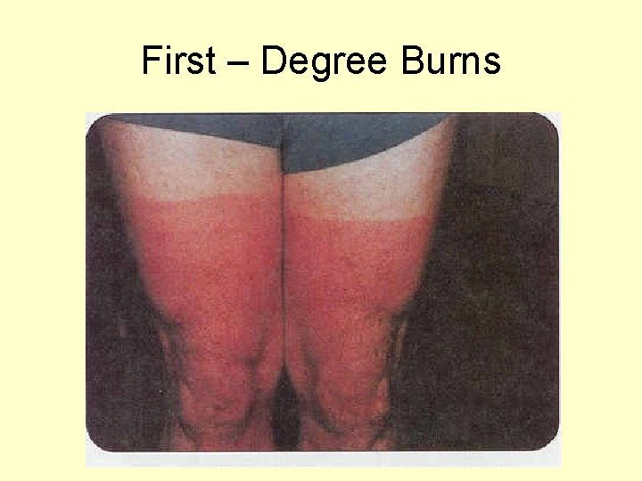 First – Degree Burns 