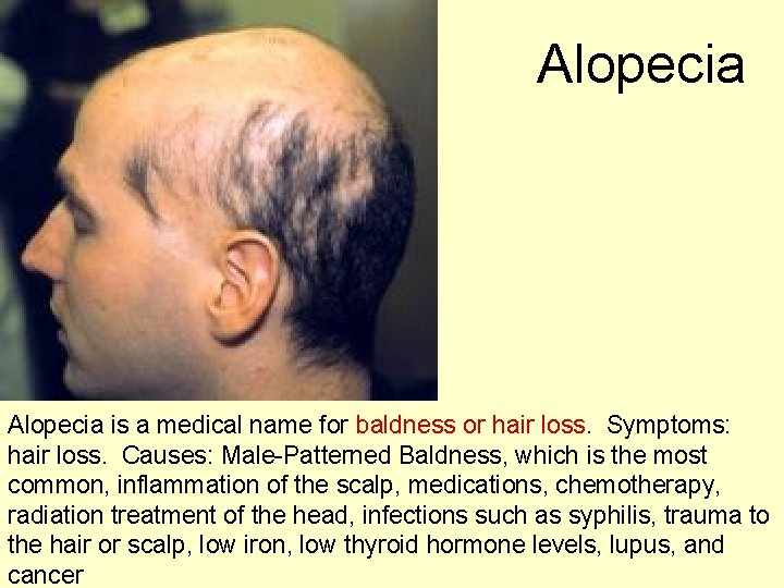 Alopecia is a medical name for baldness or hair loss. Symptoms: hair loss. Causes: Alopecia is a medical name for baldness or hair loss. Symptoms: hair loss. Causes: