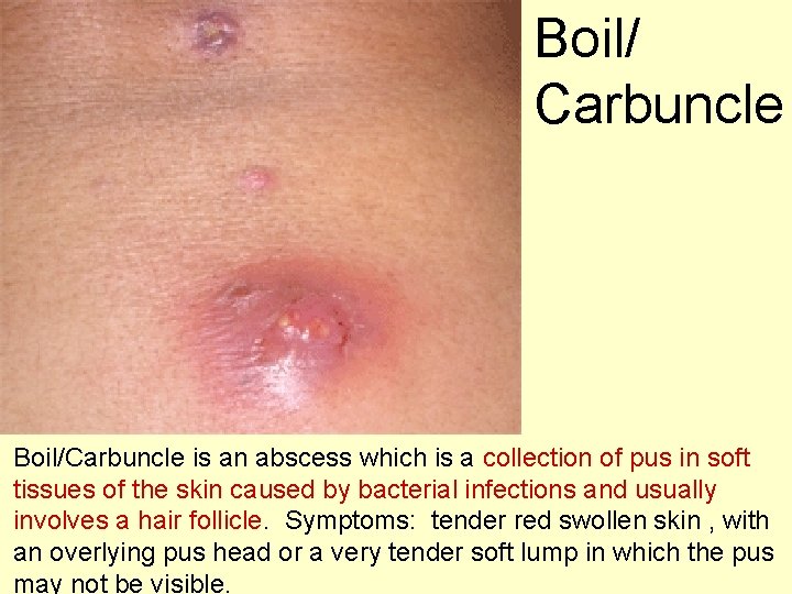 Boil/ Carbuncle Boil/Carbuncle is an abscess which is a collection of pus in soft