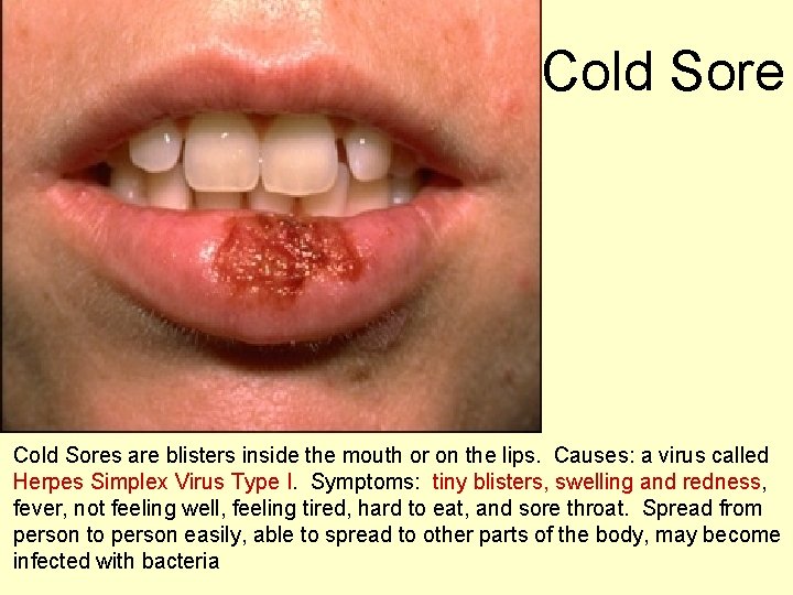 Cold Sores are blisters inside the mouth or on the lips. Causes: a virus