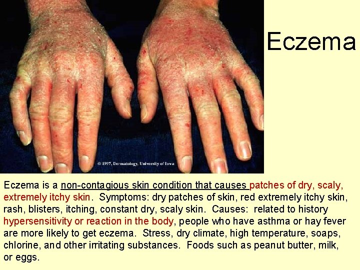 Eczema is a non-contagious skin condition that causes patches of dry, scaly, extremely itchy Eczema is a non-contagious skin condition that causes patches of dry, scaly, extremely itchy