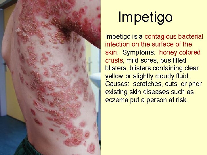 Impetigo is a contagious bacterial infection on the surface of the skin. Symptoms: honey Impetigo is a contagious bacterial infection on the surface of the skin. Symptoms: honey