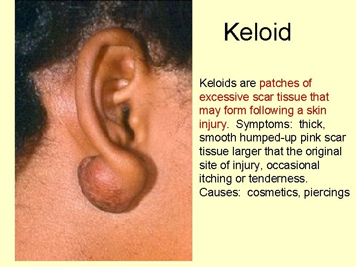 Keloids are patches of excessive scar tissue that may form following a skin injury.