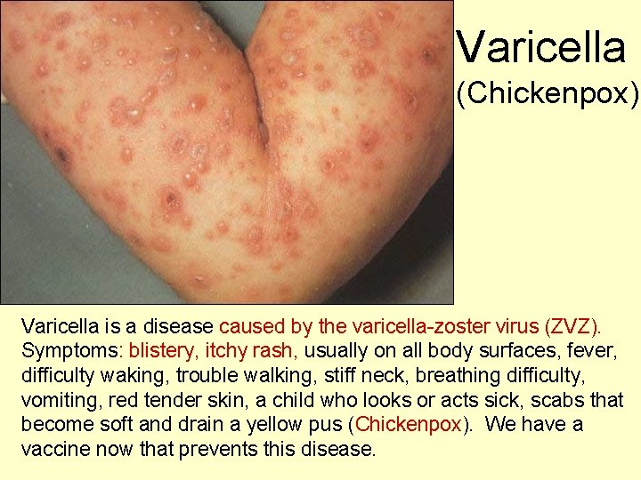 Varicella (Chickenpox) Varicella is a disease caused by the varicella-zoster virus (ZVZ). Symptoms: blistery, Varicella (Chickenpox) Varicella is a disease caused by the varicella-zoster virus (ZVZ). Symptoms: blistery,
