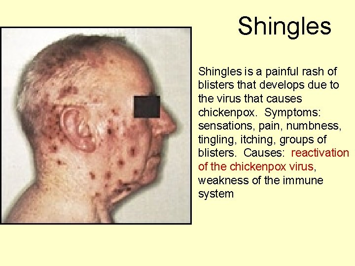 Shingles is a painful rash of blisters that develops due to the virus that