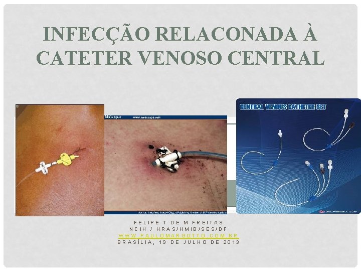 INFECÇÃO RELACONADA À CATETER VENOSO CENTRAL FELIPE T DE M FREITAS NCIH / HRAS/HMIB/SES/DF
