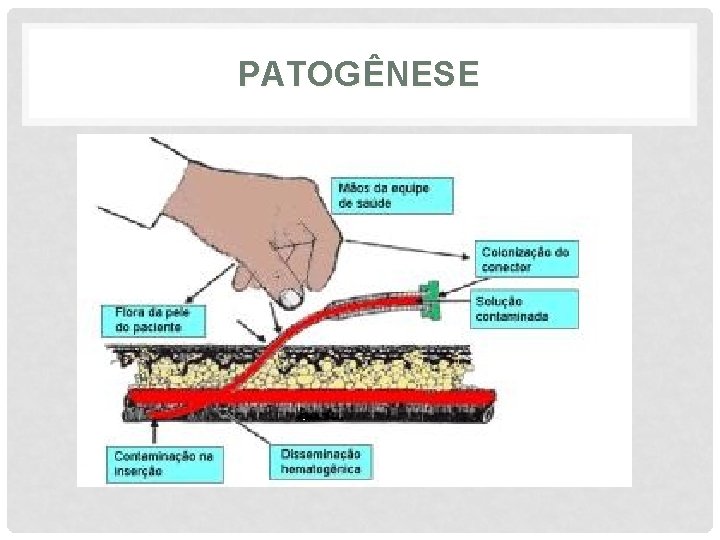 PATOGÊNESE 