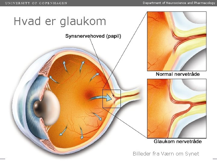 Department of Neuroscience and Pharmacology Hvad er glaukom Billeder fra Værn om Synet 