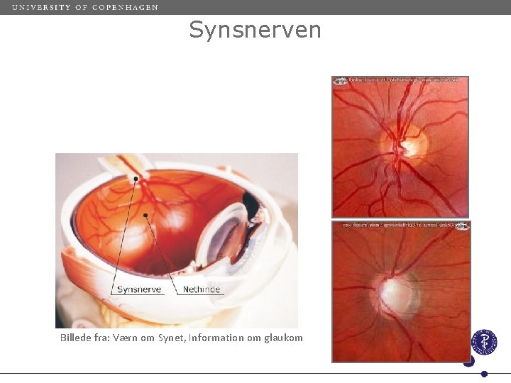 Synsnerven Billede fra: Værn om Synet, Information om glaukom 