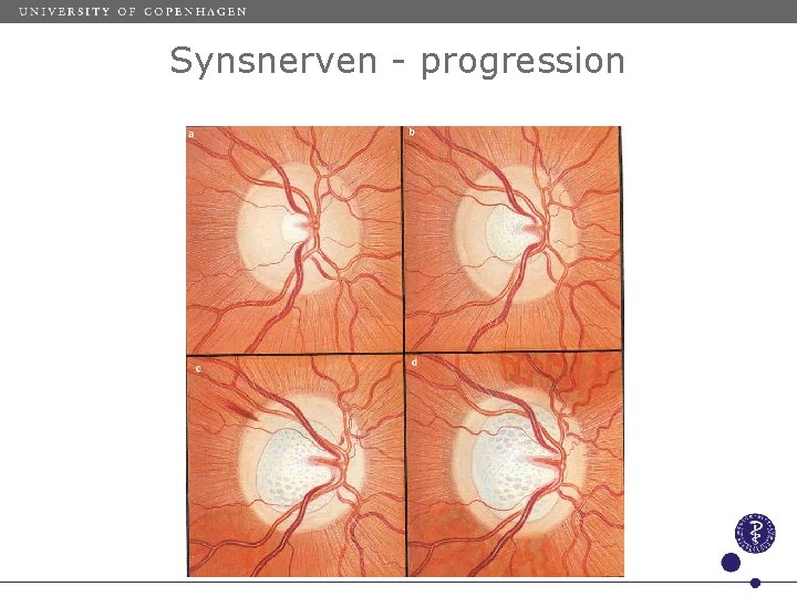 Synsnerven - progression 