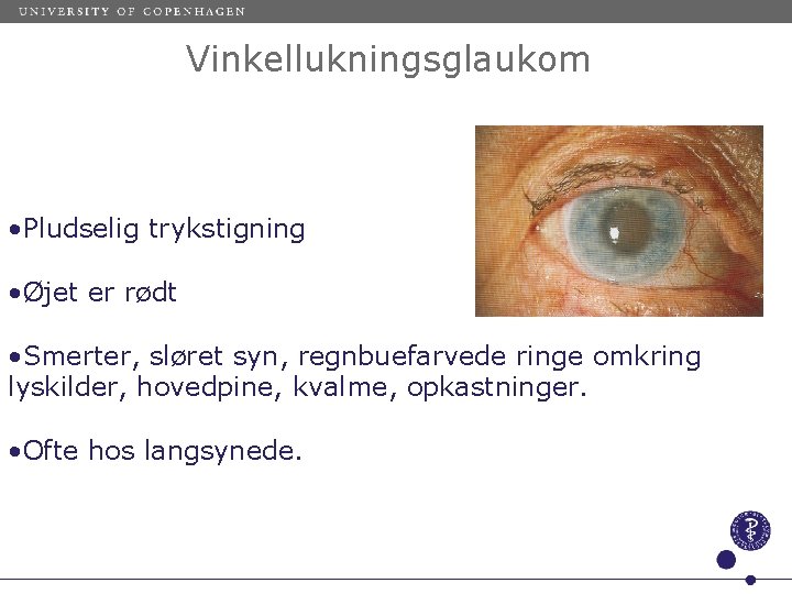 Vinkellukningsglaukom • Pludselig trykstigning • Øjet er rødt • Smerter, sløret syn, regnbuefarvede ringe