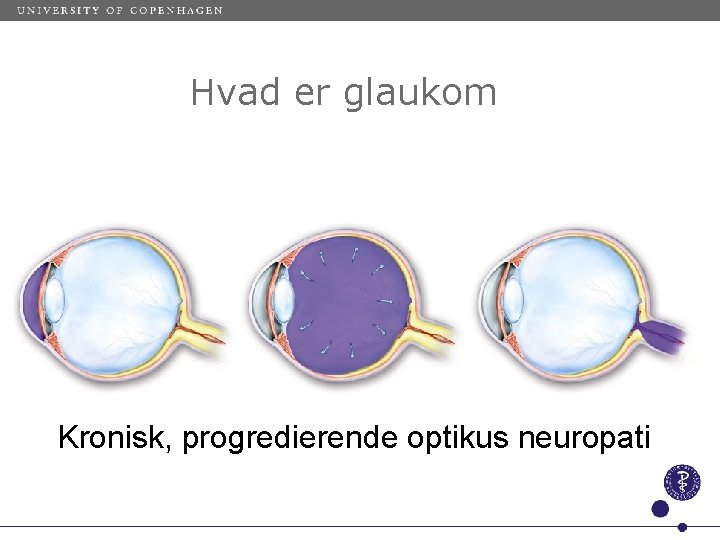Hvad er glaukom Kronisk, progredierende optikus neuropati 