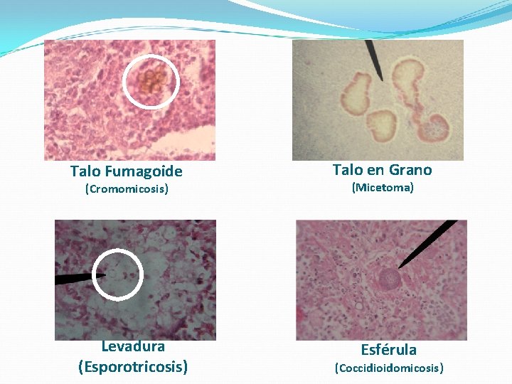 Talo Fumagoide (Cromomicosis) Levadura (Esporotricosis) Talo en Grano (Micetoma) Esférula (Coccidioidomicosis) Talo Fumagoide (Cromomicosis) Levadura (Esporotricosis) Talo en Grano (Micetoma) Esférula (Coccidioidomicosis)