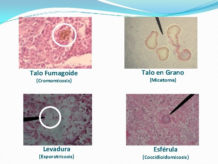 Talo Fumagoide Talo en Grano (Cromomicosis) (Micetoma) Levadura Esférula (Esporotricosis) (Coccidioidomicosis) Talo Fumagoide Talo en Grano (Cromomicosis) (Micetoma) Levadura Esférula (Esporotricosis) (Coccidioidomicosis)