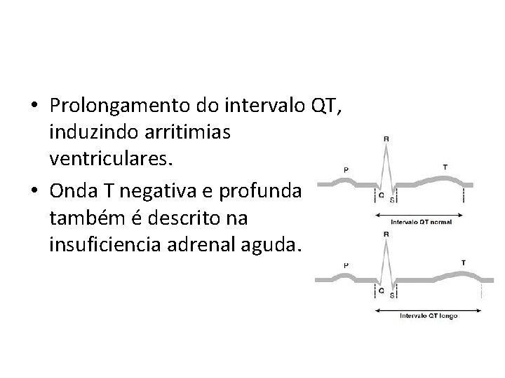  • Prolongamento do intervalo QT, induzindo arritimias ventriculares. • Onda T negativa e
