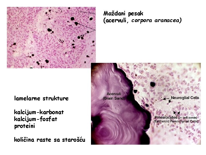 Moždani pesak (acervuli, corpora aranacea) lamelarne strukture kalcijum-karbonat kalcijum-fosfat proteini količina raste sa starošću