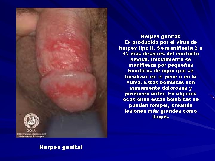 Herpes genital: Es producido por el virus de herpes tipo II. Se manifiesta 2