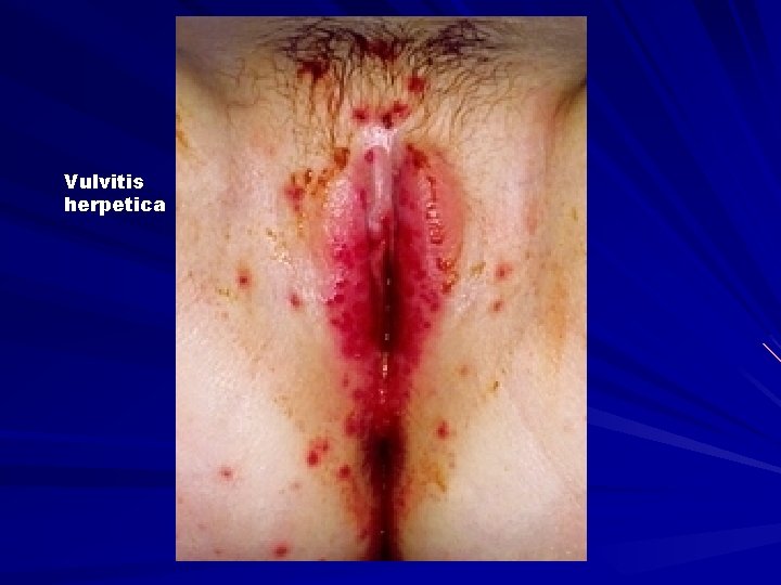 Vulvitis herpetica 