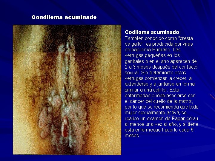 Condiloma acuminado Codiloma acuminado: También conocido como "cresta de gallo", es producida por virus