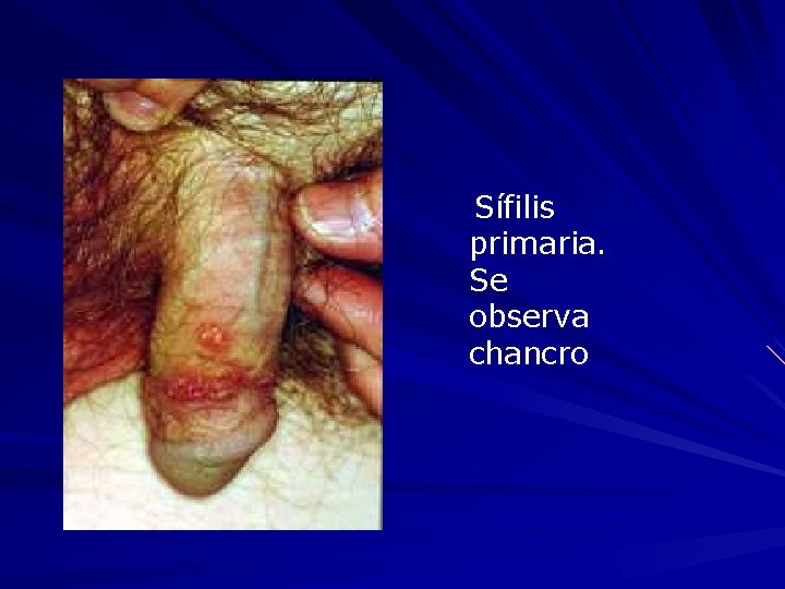  Sífilis primaria. Se observa chancro 