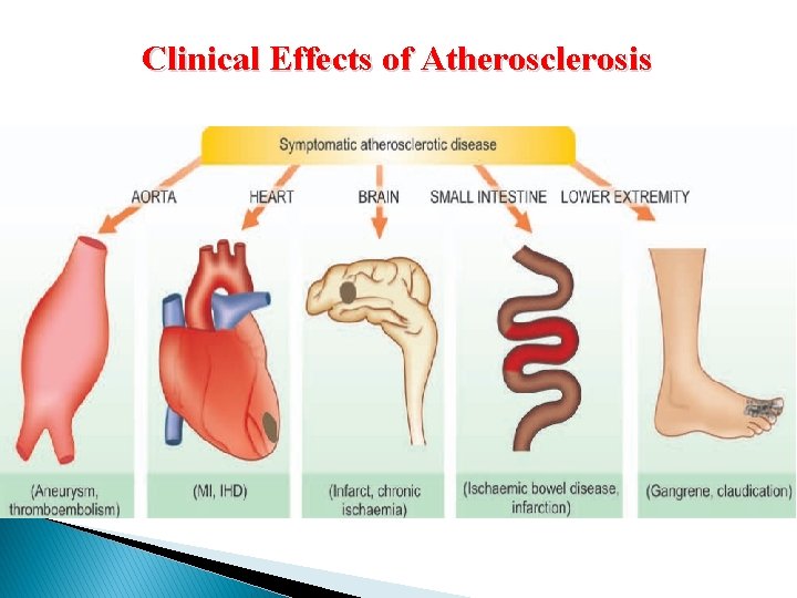 Clinical Effects of Atherosclerosis 
