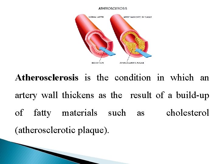 Atherosclerosis is the condition in which an artery wall thickens as the result of