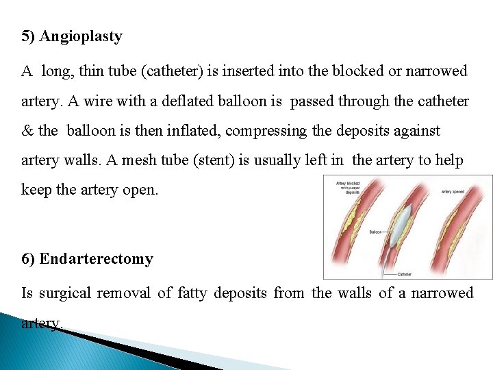 5) Angioplasty A long, thin tube (catheter) is inserted into the blocked or narrowed