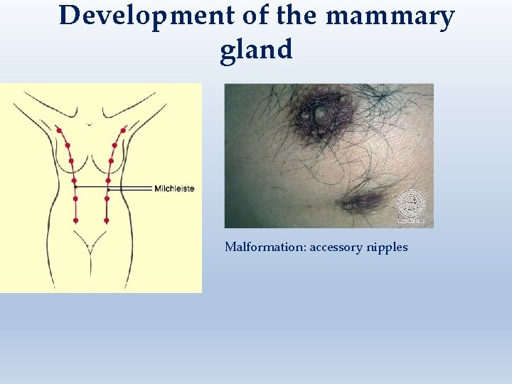 Development of the mammary gland Malformation: accessory nipples 