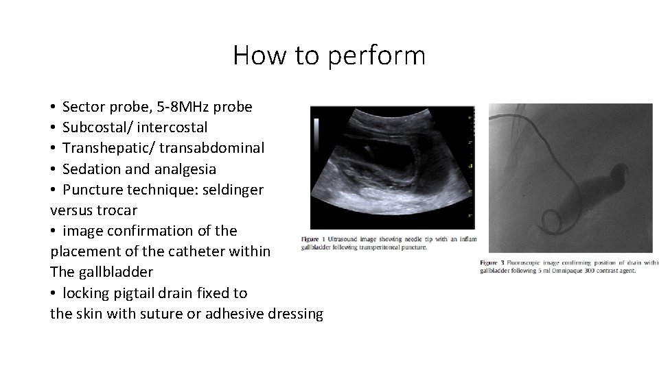 How to perform • Sector probe, 5 -8 MHz probe • Subcostal/ intercostal •