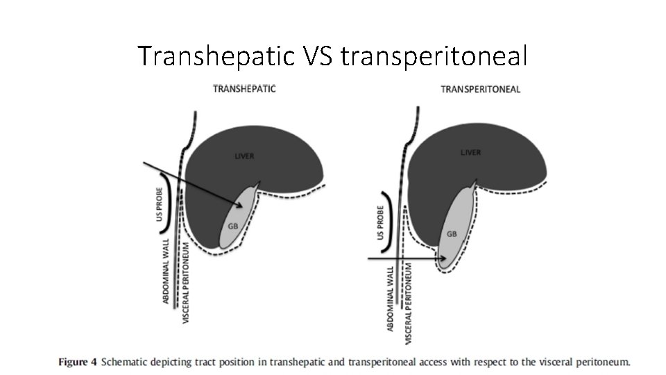 Transhepatic VS transperitoneal 