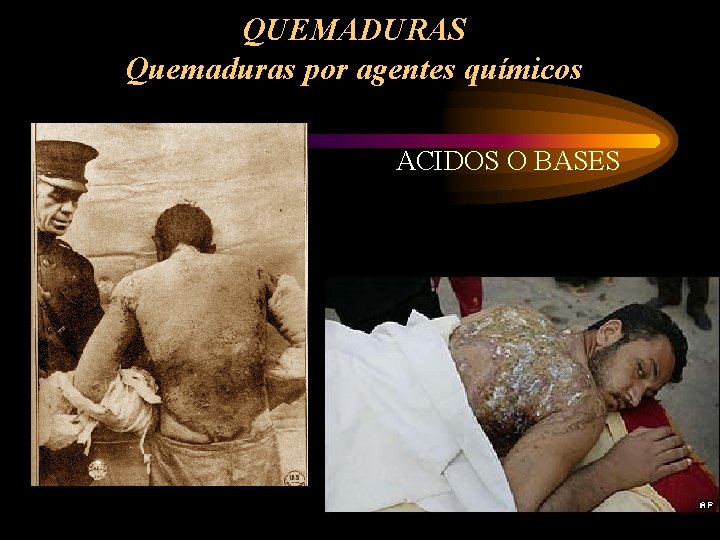 QUEMADURAS Quemaduras por agentes químicos ACIDOS O BASES 