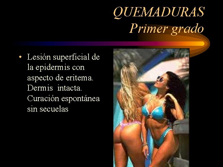 QUEMADURAS Primer grado • Lesión superficial de la epidermis con aspecto de eritema. Dermis