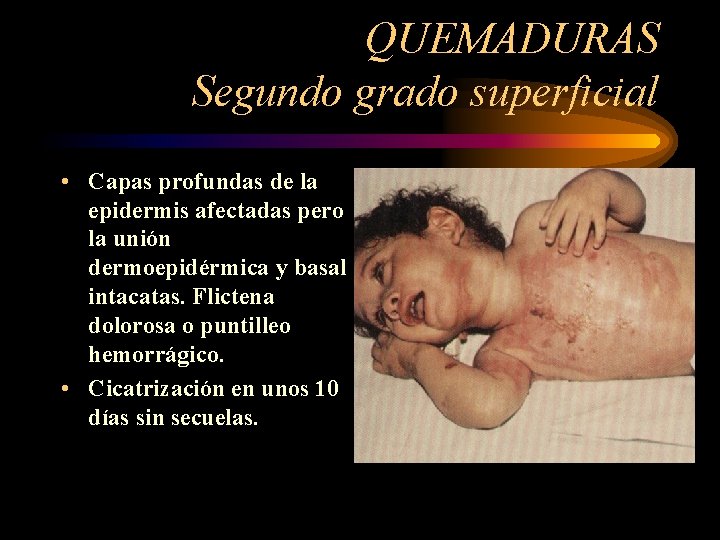 QUEMADURAS Segundo grado superficial • Capas profundas de la epidermis afectadas pero la unión