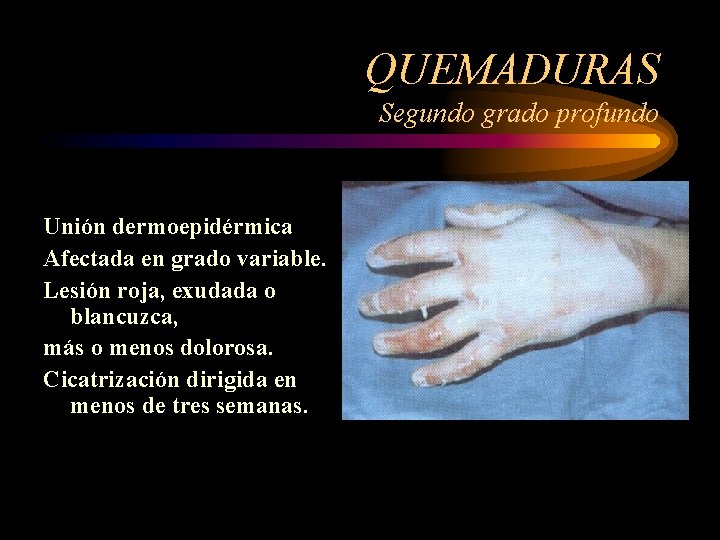 QUEMADURAS Segundo grado profundo Unión dermoepidérmica Afectada en grado variable. Lesión roja, exudada o