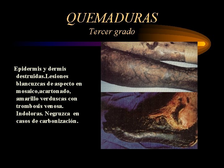 QUEMADURAS Tercer grado Epidermis y dermis destruidas. Lesiones blancuzcas de aspecto en mosaico, acartonado,