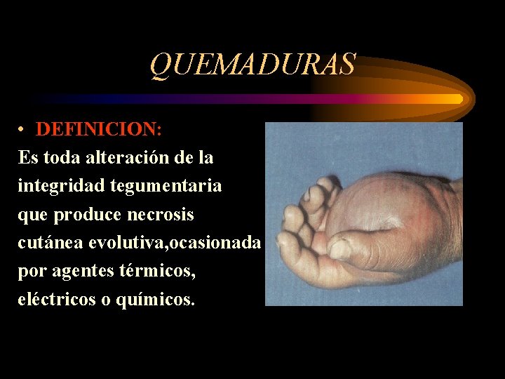 QUEMADURAS • DEFINICION: Es toda alteración de la integridad tegumentaria que produce necrosis cutánea