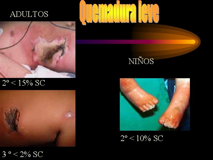 ADULTOS NIÑOS 2º < 15% SC 2º < 10% SC 3 º < 2%