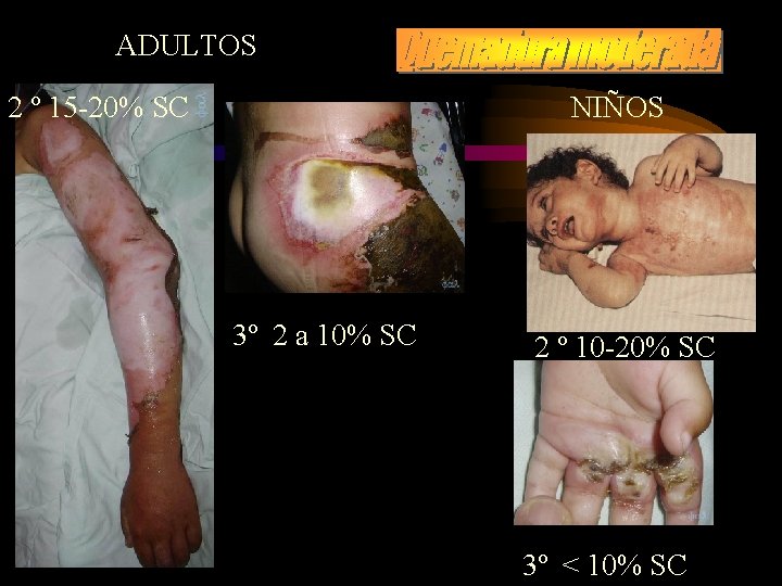 ADULTOS 2 º 15 -20% SC NIÑOS 3º 2 a 10% SC 2 º