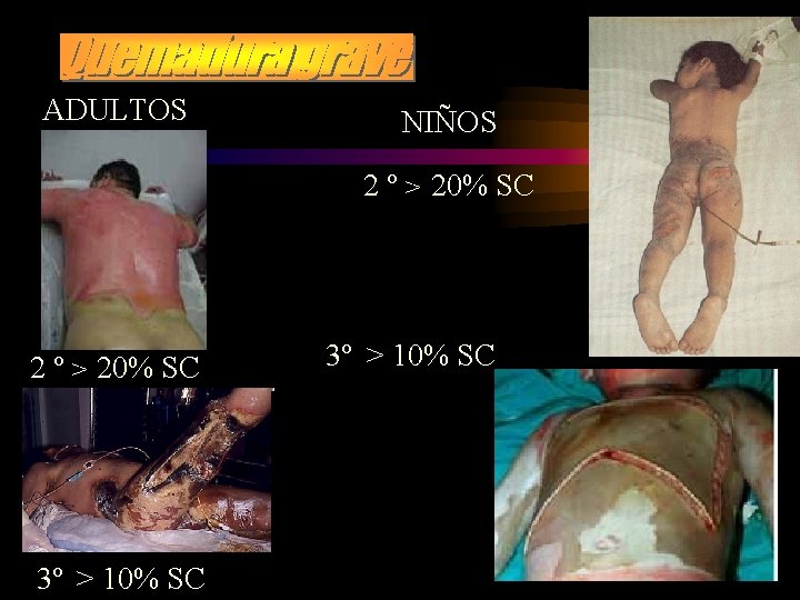 ADULTOS NIÑOS 2 º > 20% SC 3º > 10% SC 