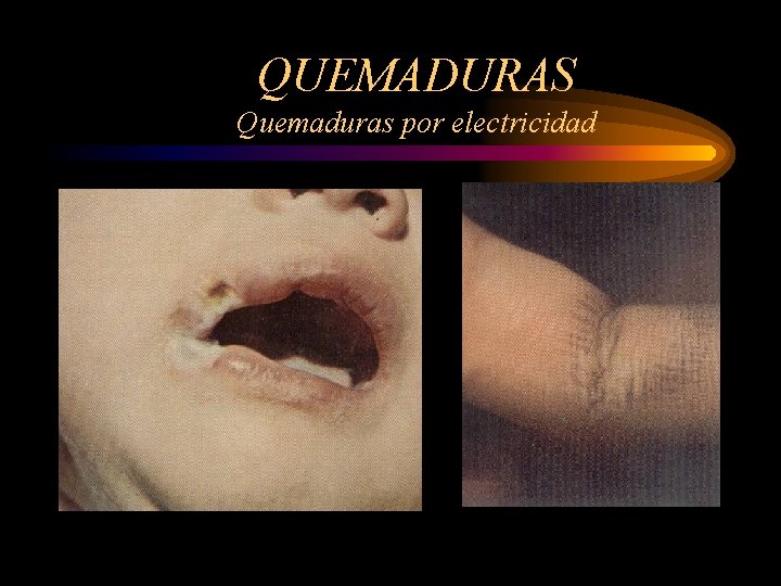 QUEMADURAS Quemaduras por electricidad 
