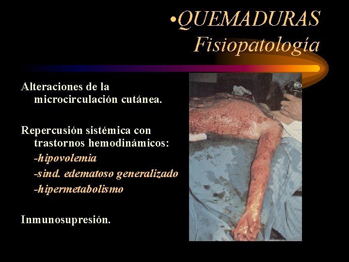  • QUEMADURAS Fisiopatología Alteraciones de la microcirculación cutánea. Repercusión sistémica con trastornos hemodinámicos: