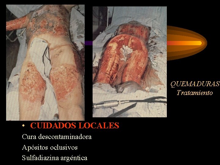 QUEMADURAS Tratamiento • CUIDADOS LOCALES Cura descontaminadora Apósitos oclusivos Sulfadiazina argéntica 