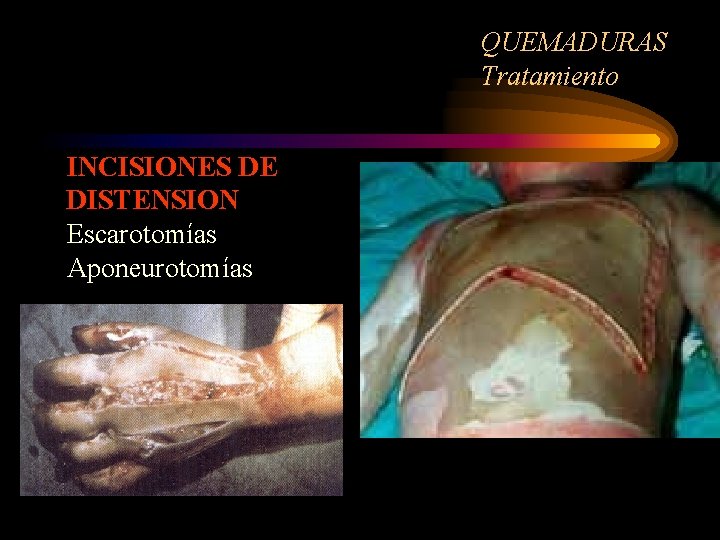 QUEMADURAS Tratamiento INCISIONES DE DISTENSION Escarotomías Aponeurotomías 